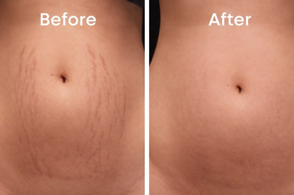 Stretch Mark Prevention Cream